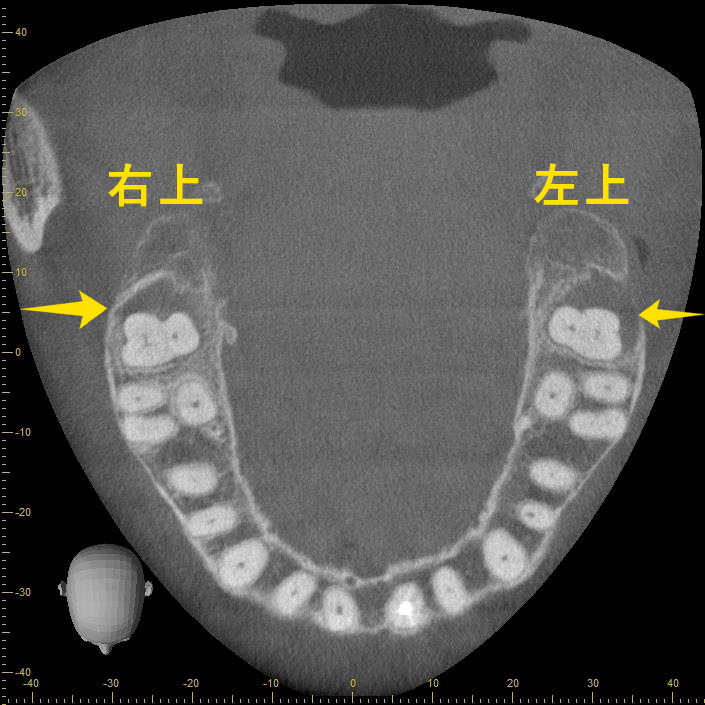 手術前全体レントゲン写真